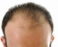 Mitos y Verdades de la Caída Del Pelo