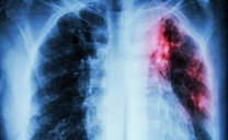 Llaman a Informarse y Realizar Exámenes Preventivos Contra La Tuberculosis