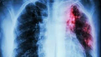 Llaman a Informarse y Realizar Exámenes Preventivos Contra La Tuberculosis