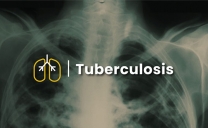 Diputado Castro Pide a Las Autoridades Sanitarias Informar Campañas Preventivas Contra la Tuberculosis