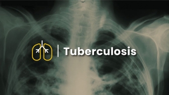 Diputado Castro Pide a Las Autoridades Sanitarias Informar Campañas Preventivas Contra la Tuberculosis